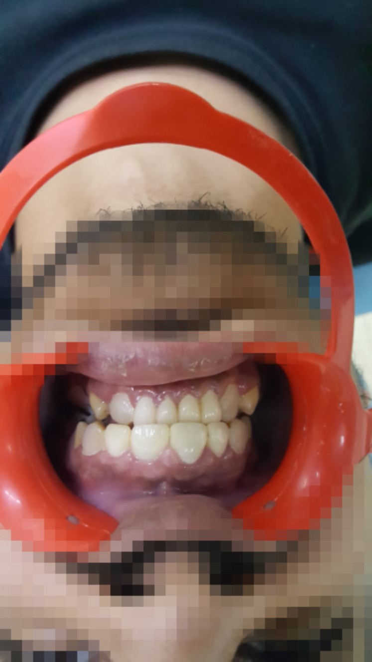 Before and after professional cleaning and stain removal at Manglam Dental Clinics