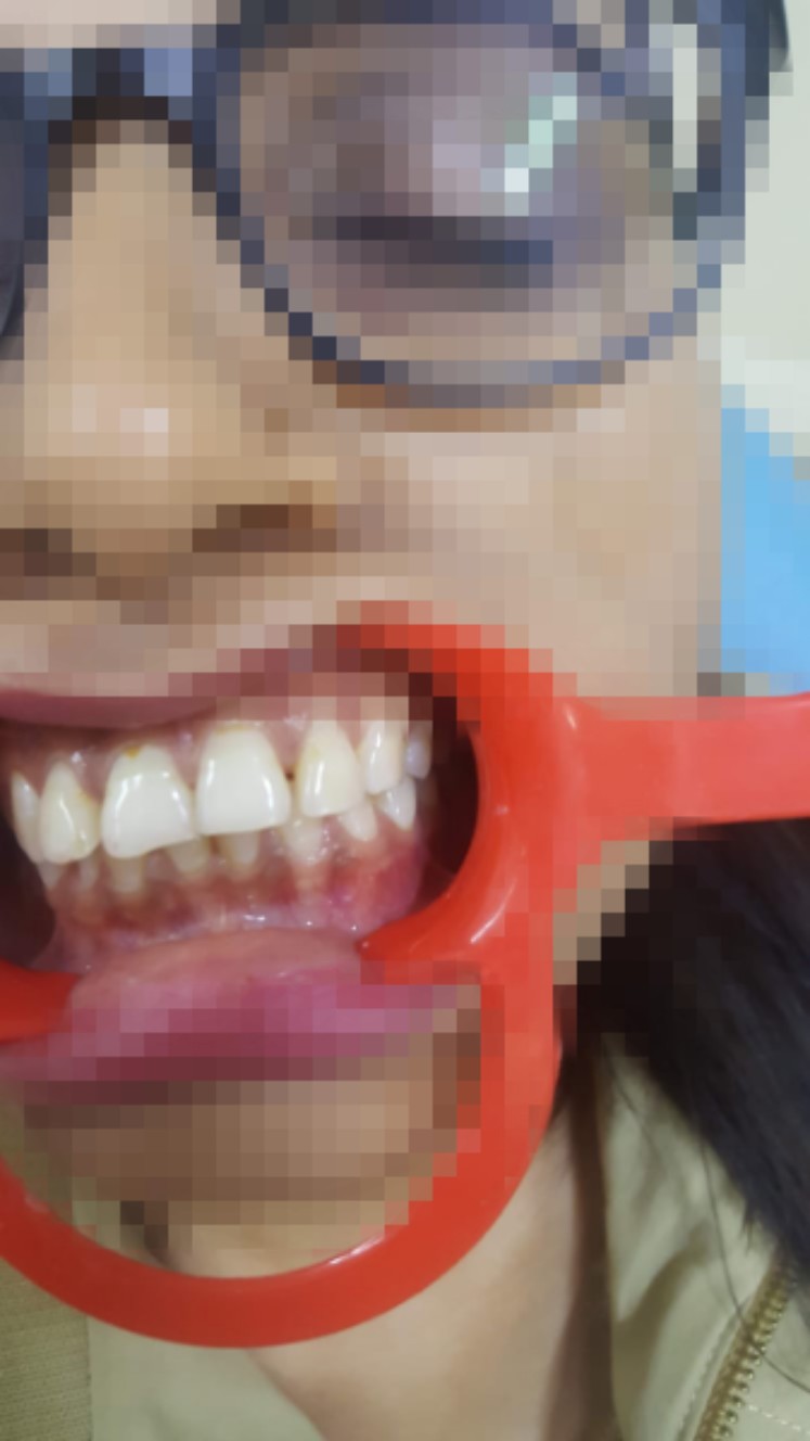 Before and after professional cleaning and stain removal at Manglam Dental Clinics