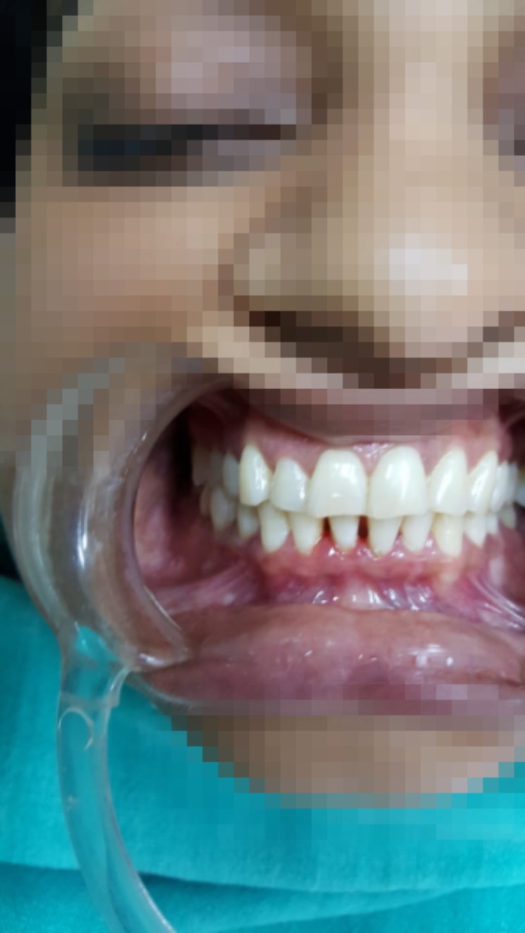 Before and after scaling, polishing and restoration at Manglam Dental Clinics