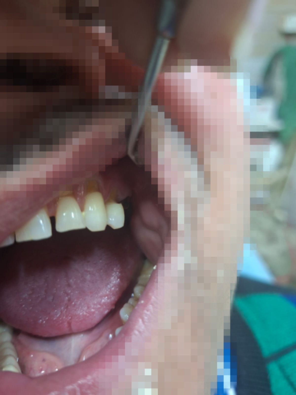 Before and after scaling, polishing and restoration at Manglam Dental Clinics